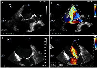 Multimodality Imaging in Secondary Mitral Regurgitation